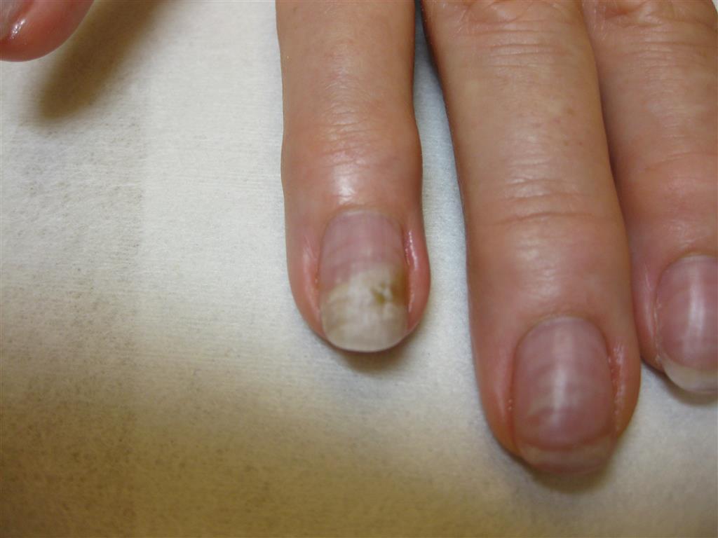 Fungal Nail - How to cure? | Rainbow Nails' Blog