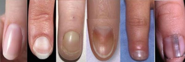 From vitamin deficiency to heart-related issues, know symptoms visible in  nails linked to health conditions